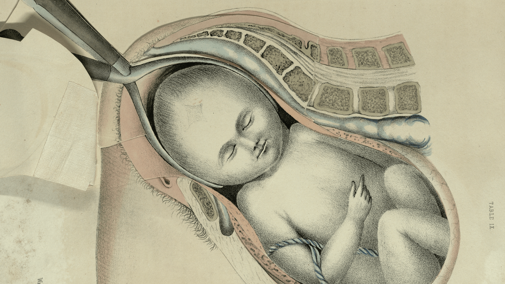 Anatomical illustration of a baby being pulled from its mother with forceps
