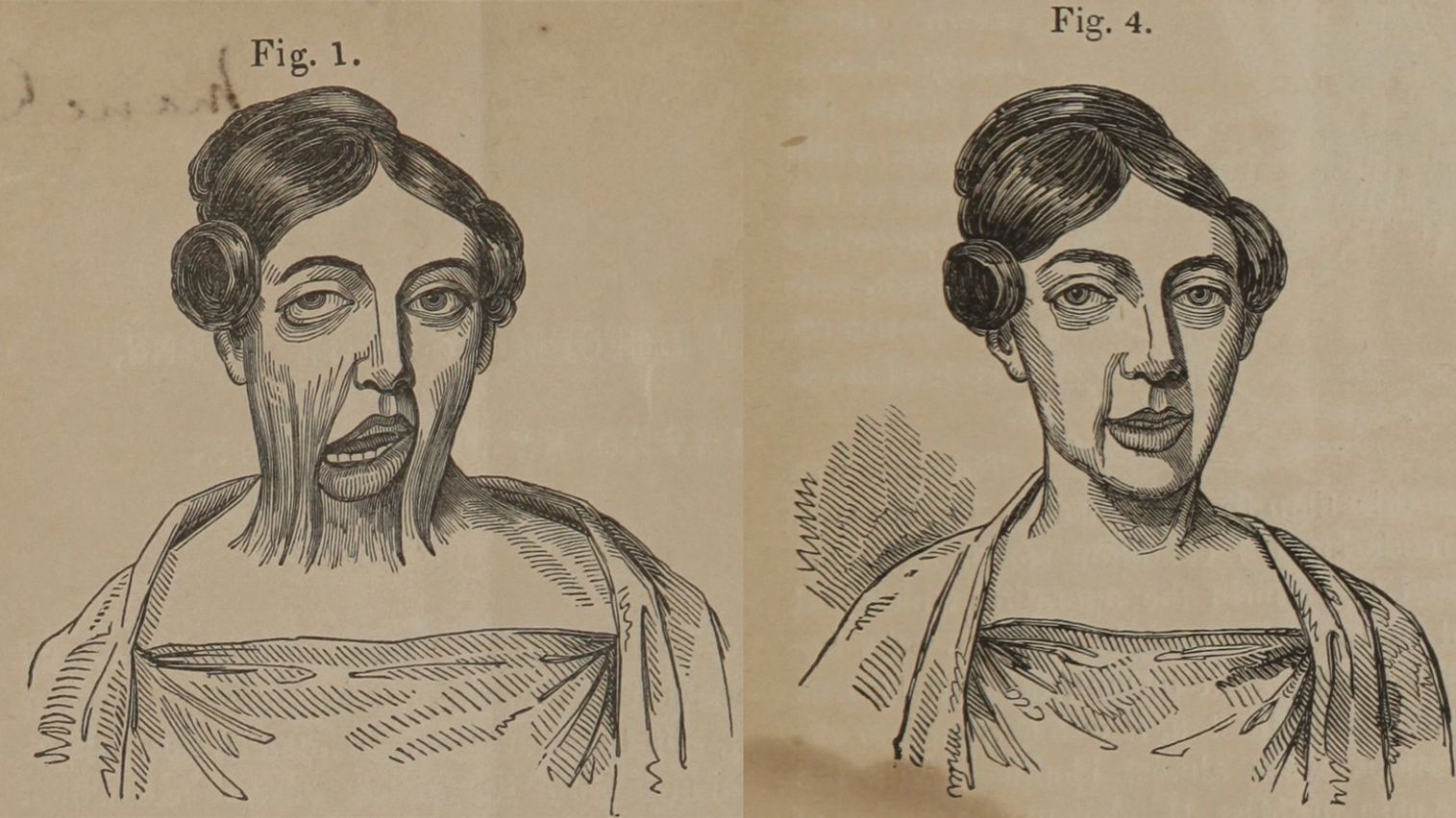 Two llustrations of a woman: one with significant deformity to the skin of her neck and face, and one with no evidence of deformity